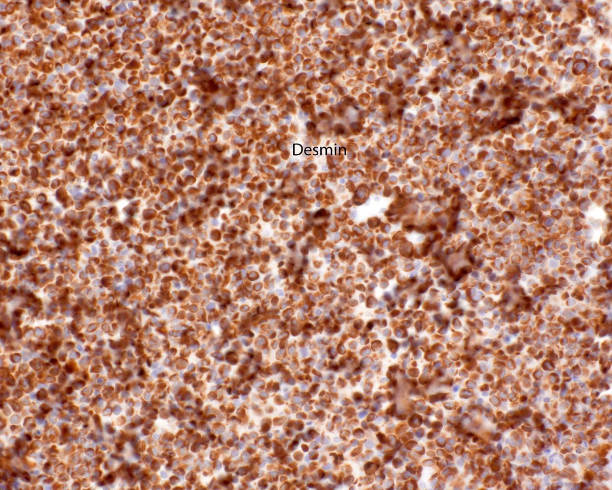 This alveolar rhabdomyosarcoma in the orbital region of an adult spread to a regional lymph node.  Awful lesion.