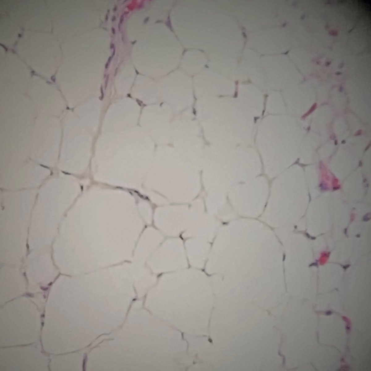 Why is there adipose tissue in this endometrial biopsy specimen?  Something you don’t want to see.  #uterinerupture