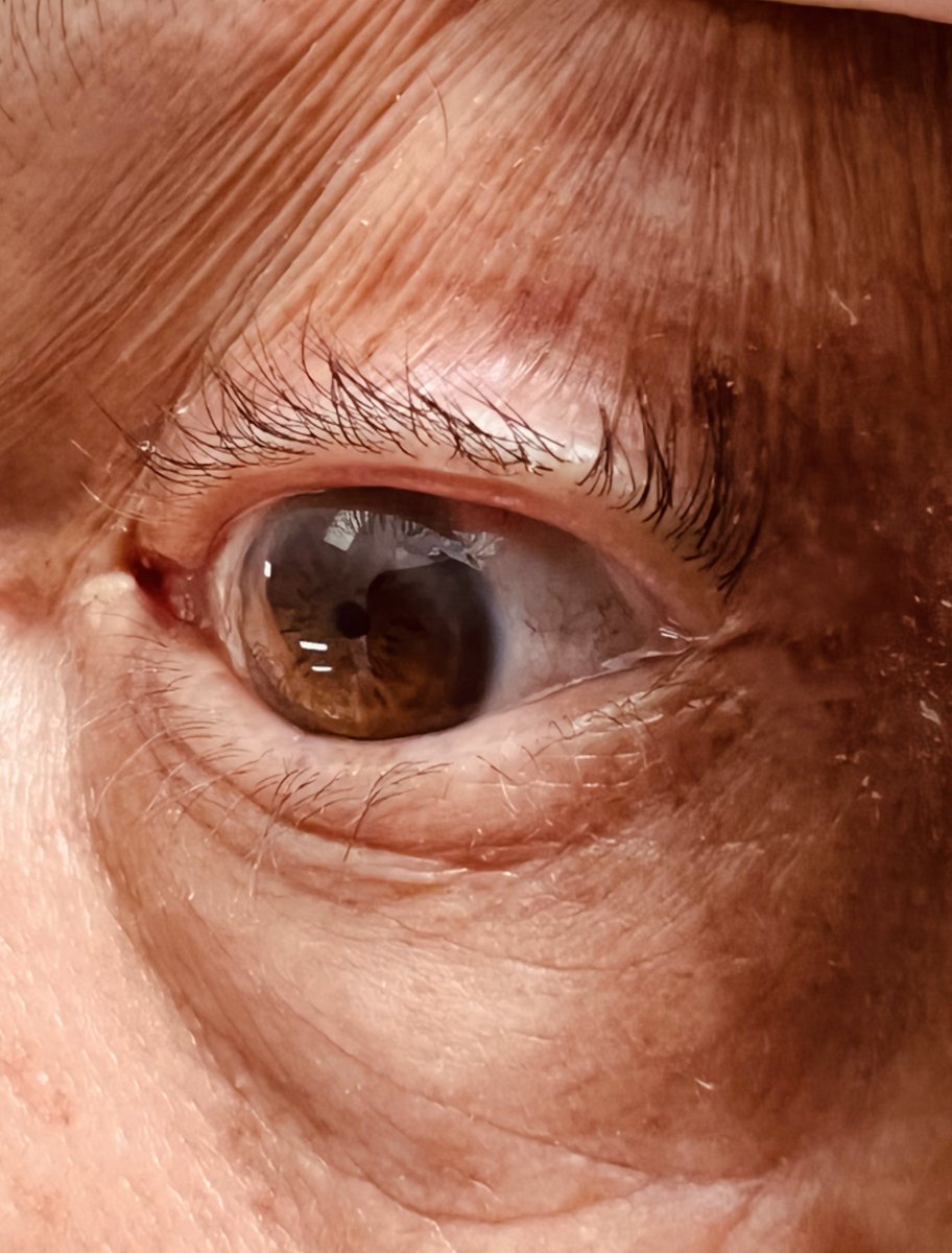 umanamd's tweet photo. …and of course, the classic pin-point pupils.
#Organophosphate
#EMimages #EMcases https://t.co/P8lowJ3DjO
