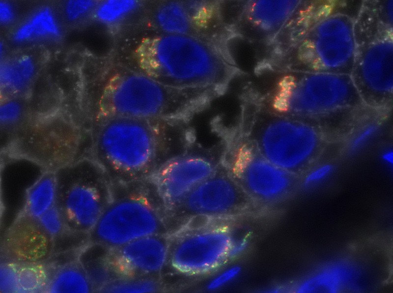 By exploring the tumor genome and proteome together, #CPTAC collaborators from @bcmhouston, Broad & @WUSTL have found new markers for chemotherapy resistance in triple negative #breastcancer, opening the door to better #TNBC outcome prediction. broad.io/Proteogenomics…