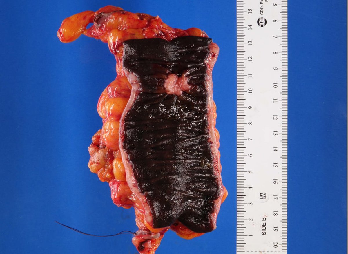 Happy Wednesday #PathTwitter #GIpath 

What can we diagnose on gross exam?
Hint: there's no ink on this specimen