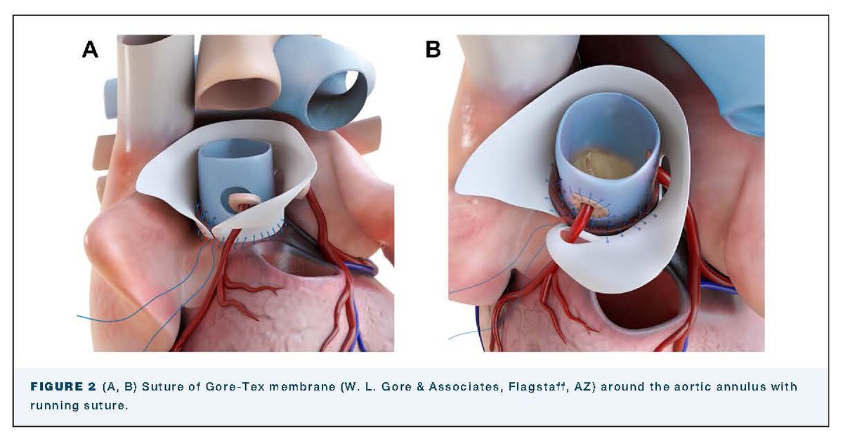 The Annals of Thoracic Surgery tweet media