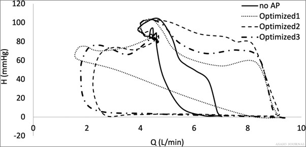 asaiojournal's tweet image. #OnlineFirst A Mathematical Model of Artificial Pulse Synchronization for the HeartMate3 Left Ventricular Assist Device
ow.ly/AXZ150KoQWs
@SDSU 

#ArtificialPulse #Pulsatility #LVAD #MathematicalModel #BiomedicalEngineering