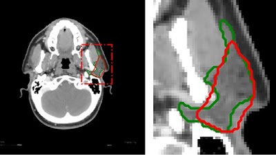 Radiology: Artificial Intelligence (@radiology_ai) on Twitter photo Using #DeepLearning models to assist clinicians in editing contours efficiently and effectively doi.org/10.1148/ryai.2… @MangoHuge <a href="/MAIA_Laboratory/">Medical Artificial Intelligence and Automation Lab</a> <a href="/UTSW_RadOnc/">UTSW Radiation Oncology</a> #RadOnc #ML #MachineLearning Using #DeepLearning models to assist clinicians in editing contours efficiently and effectively doi.org/10.1148/ryai.2… @MangoHuge <a href="/MAIA_Laboratory/">Medical Artificial Intelligence and Automation Lab</a> <a href="/UTSW_RadOnc/">UTSW Radiation Oncology</a> #RadOnc #ML #MachineLearning