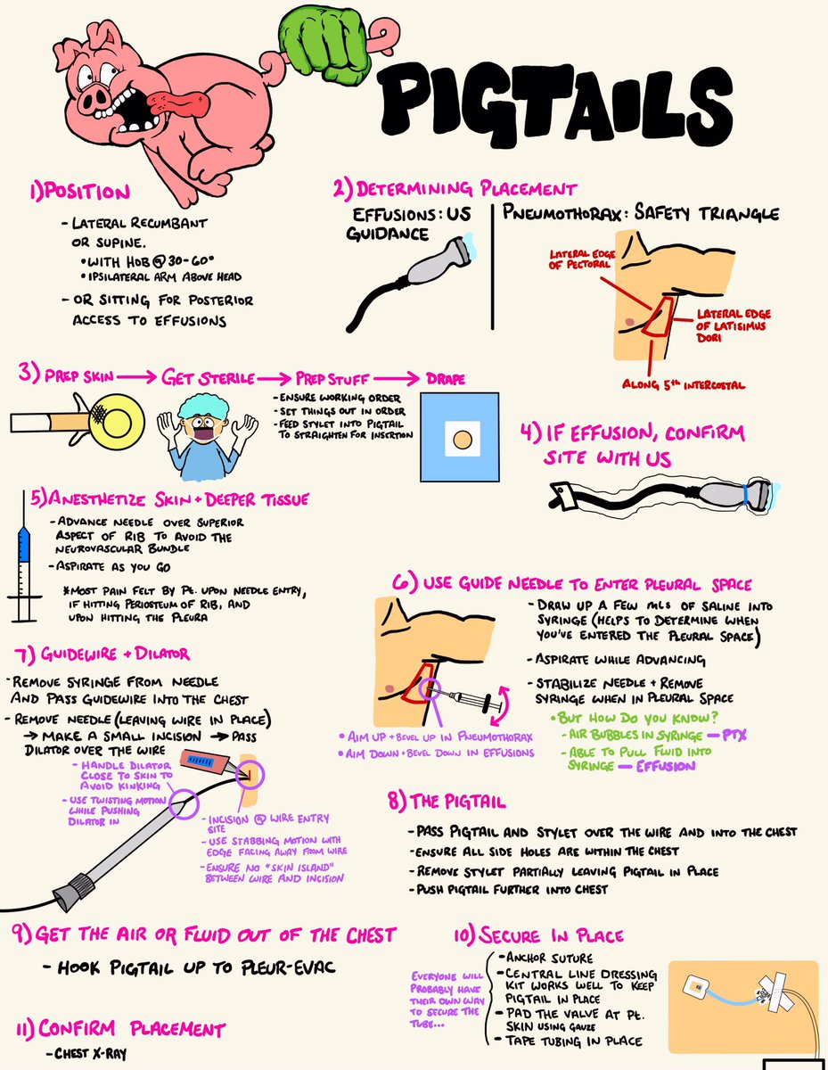 Because all chest tubes should be named after animal tails. #FOAMed #FOAMcc #MedTwitter #ICU
