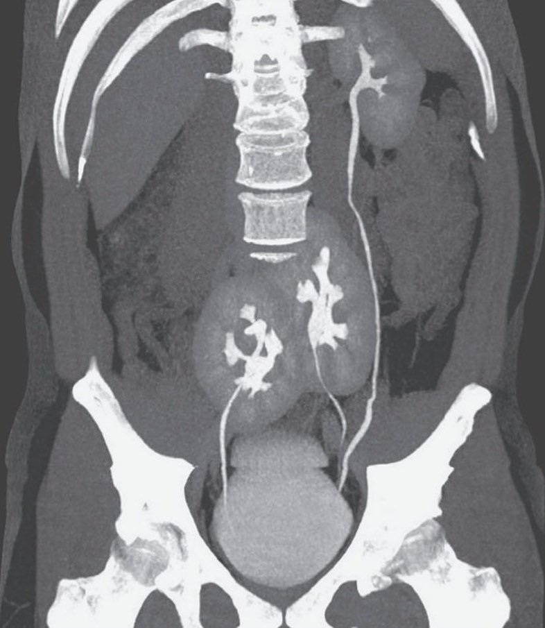 MsCiencia2's tweet photo. Paciente de 38 años consulta por dolor lumbar, le piden una TAC y se encuentran 3 riñones. 

📸 NEJM https://t.co/oWfUUUt0AE