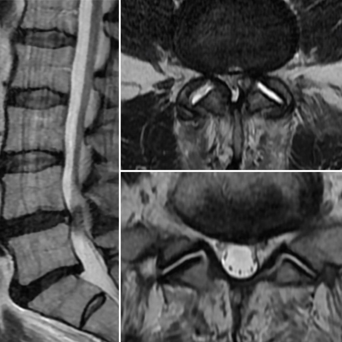 You asked for a disc herniation! This case highlights the importance of a thorough history, exam, and current imaging. L leg pain: large left L5/S1 disc MRI 18 mo later shows a left L4/5 synovial cyst with resorption of disc! No surgery. Don’t assume it’s still the same pathology