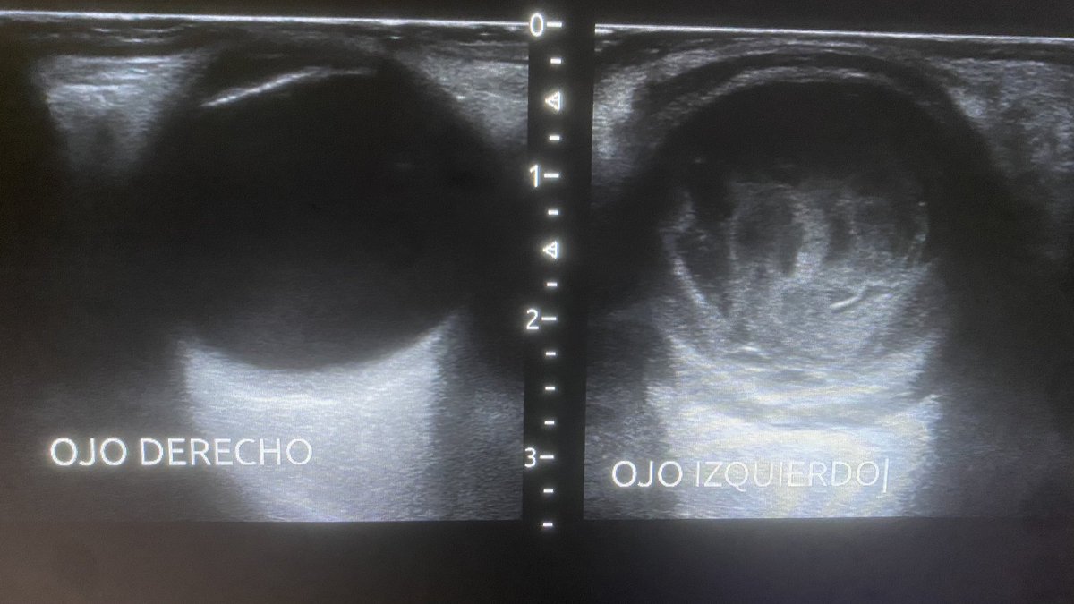 DannySilvaC1's tweet photo. Endoftalmitis incidencia entre 0.02 % causado por patogenos G+/- mas en DM, tto desde ATB intra vitrio hasta enucleación 💡estemos alerta #oftalmología #medicinainterna ⁦@drdpvera⁩ ⁦⁦@Monytovar0510⁩ @Ernesto56385712 ⁦@mirellakbr⁩ https://t.co/po1YBcO15j