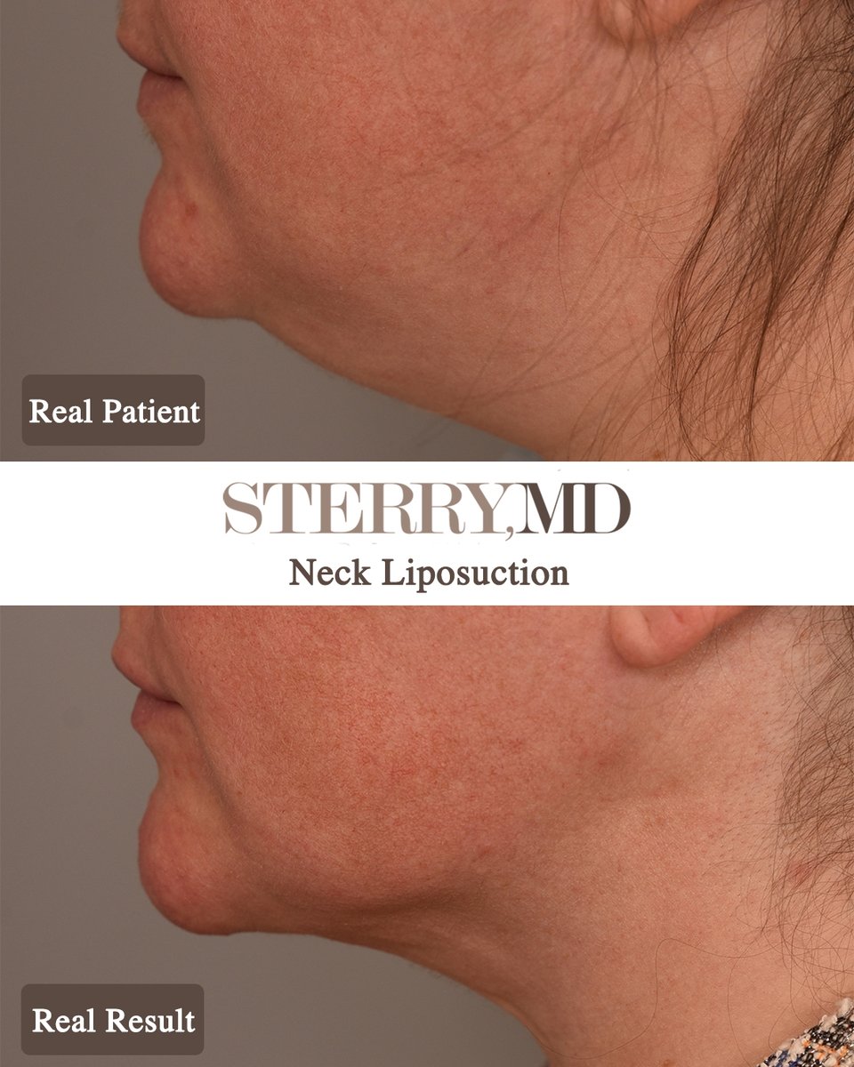 Neck Liposuction removes areas of fat in the neck to give the chin line its definition. 

This procedure provides satisfying results rather quickly!

📸 Results are shown 3 months post-procedure.

#chinliposuction #chinliponyc #beforeandafterliposuction #doublechinremoval
