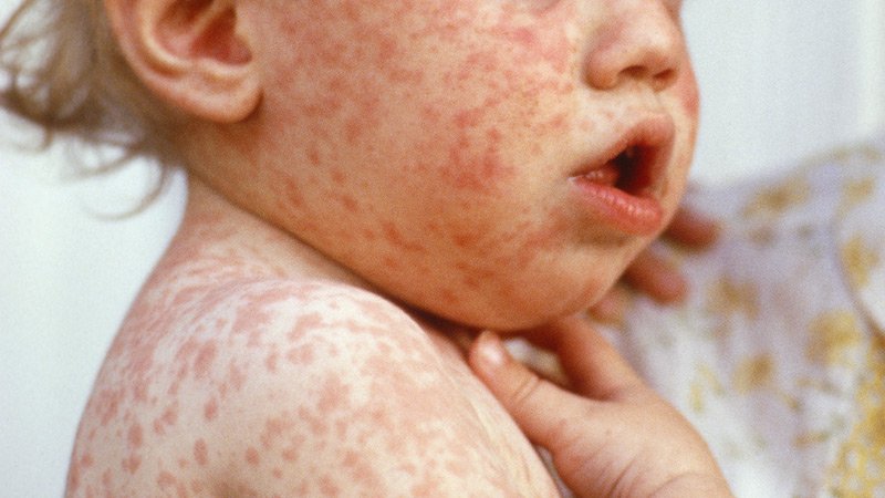 Acknowledging that the country’s measles vaccine mandate interfered with the rights of children and their parents, the German constitutional court said it was justified due to the high infection risk with measles and potential for serious illness. ms.spr.ly/6015jjAUB