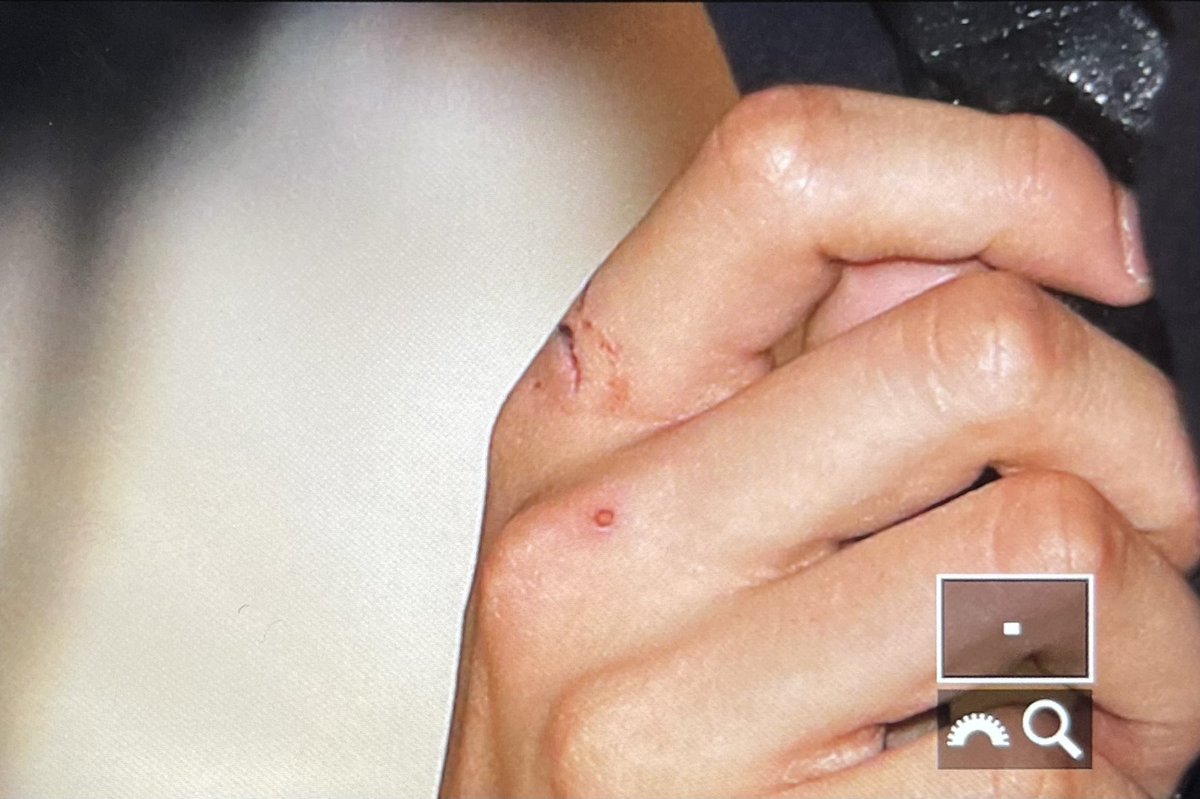 haechanconfess's tweet image. liat jarinya haechan luka 😿