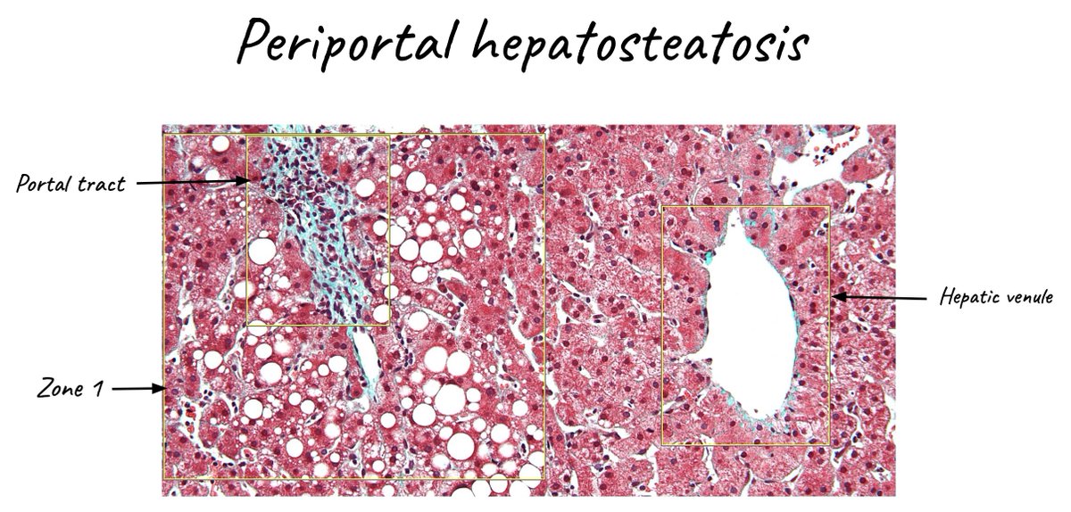 Look at that 😯macrovesicular steatosis in zone 1 🔬👇

✅Lipid filled hepatocytes with large fat droplets
✅Pushing nucleus to the periphery

#PathTwitter #ATPathNuggets