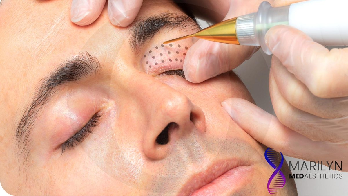 ViveloPR's tweet photo. #TerminaHOy👁️👁️#GuaynabO ¡Párpados Nuevos! ➔ https://t.co/TrcXMjpCBP Tratamiento para párpado superior e inferior de Plasma 'Pen Fibroblast' y evaluación gratis por $199 en vez de $800 (Separa con $49) 

#MarilynMedAesthetics #GastaMenosViveMás #AhOrraConOfertones https://t.co/KgzerDOLlH