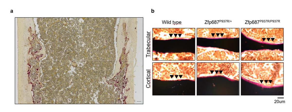 Sharon_russo_'s tweet photo. (3/7) In cortical bone of mutant mice, we found #osteolytic lesions, with giant-sized and hyper-activated #osteoclasts (a). We also described altered matrix deposition by P937R mutant #osteoblasts (b), resulting in increased deposition of non-mineralised bone matrix. https://t.co/WX3gmOc9qv