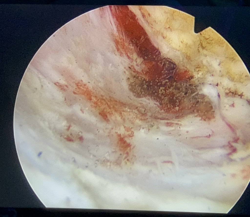 jgv_urologo's tweet photo. This is the main actor of this movie!! the lead actor... and the final results: Este es el protagonista d esta película y los resultados: very thankful with #greenLEP @RRGonzalezMD @VMisrai @enrique_rijo https://t.co/u0V4zZ70XS
