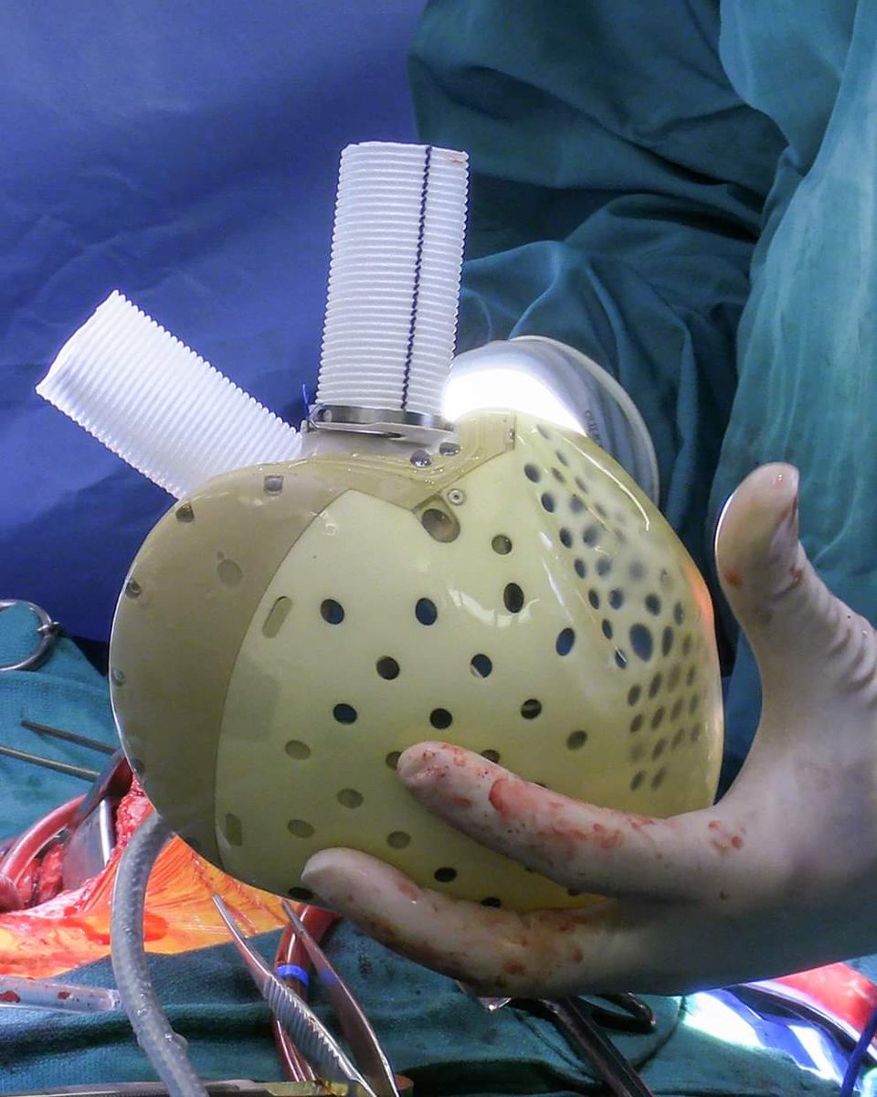 ab2kone's tweet photo. (⛑️) Voici le 1er cœur complètement artificiel a avoir été greffé avec succès ! ❤️🤖

C'était en juillet 2021 : l'hôpital universitaire de Duke a transplanté un cœur totalement artificiel chez un homme de 39 ans qui a connu une insuffisance cardiaque soudaine. https://t.co/yTkt5qHT3J