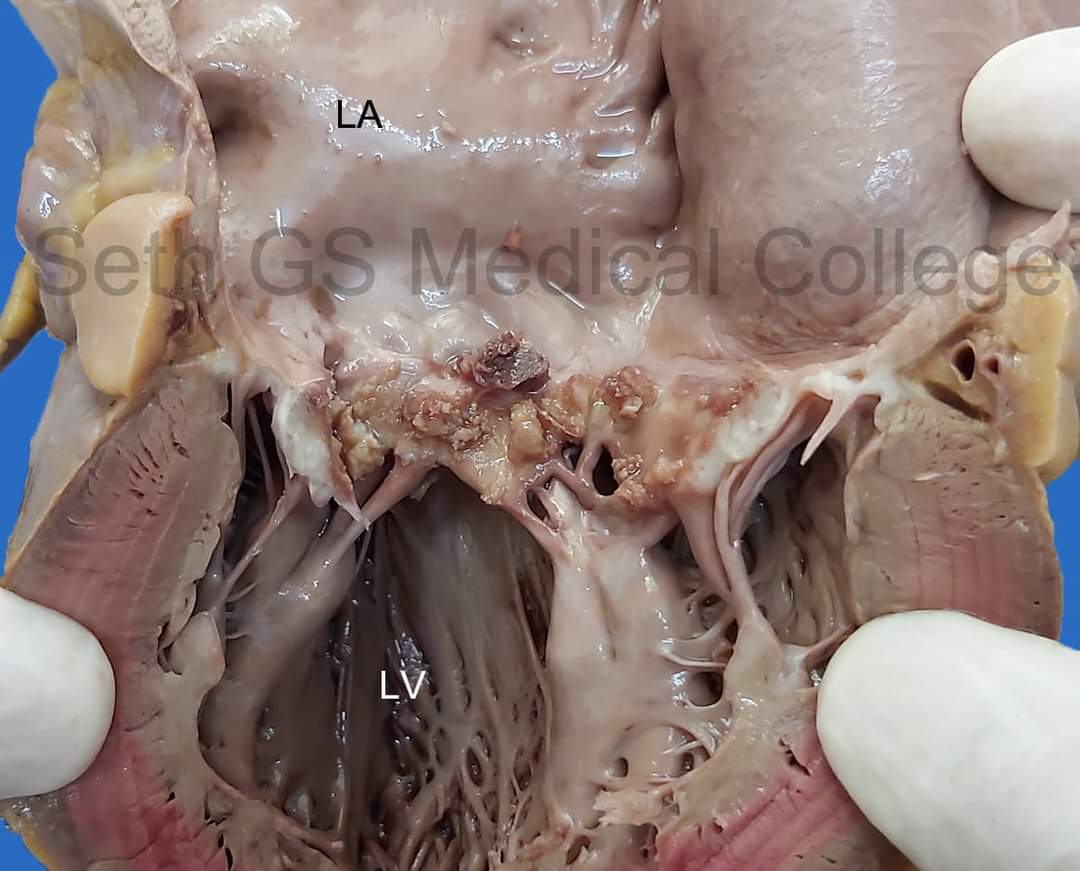 #COTW - 28 years, Female; Maternal mortality