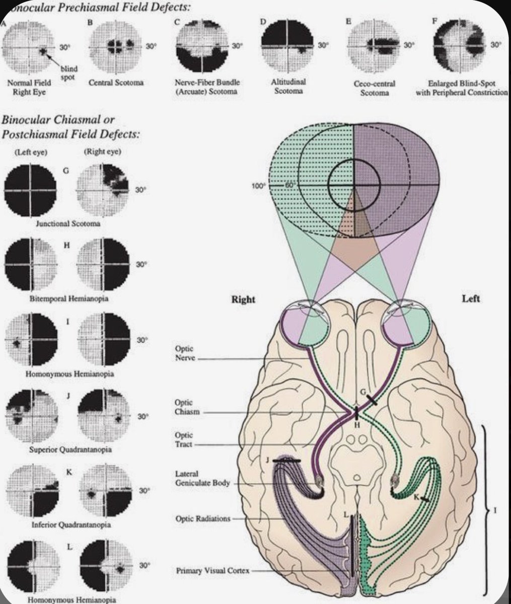 OGdukeneurosurg's tweet image. Know your optic pathway and visual field deficits from s-media-cache-akO.