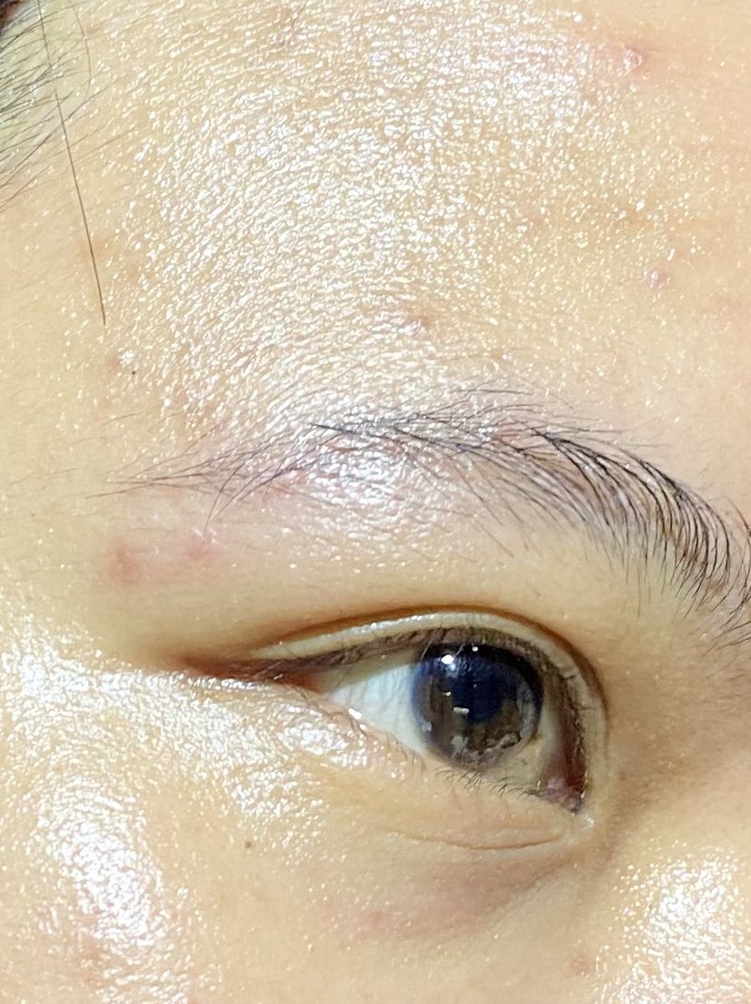 keshikiayame's tweet photo. Essence bener2 membantu banget mengatasi merah2🙏🏻 kalo kulitku lagi rewel kayak gini aku pasti gempur terus pake hydrating product. 
Menurutku porduk ini worth it dapet 5 manfaat dlm 1 botol, yuk baca review aku⤵️ 
#racuninskincare 

before                           after https://t.co/9LcnQLoesh