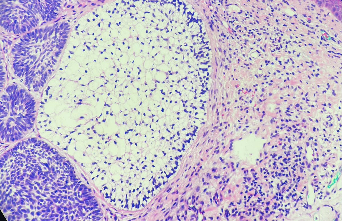 BCC with clear cell change #dermpath #PathTwitter #dermtwitter