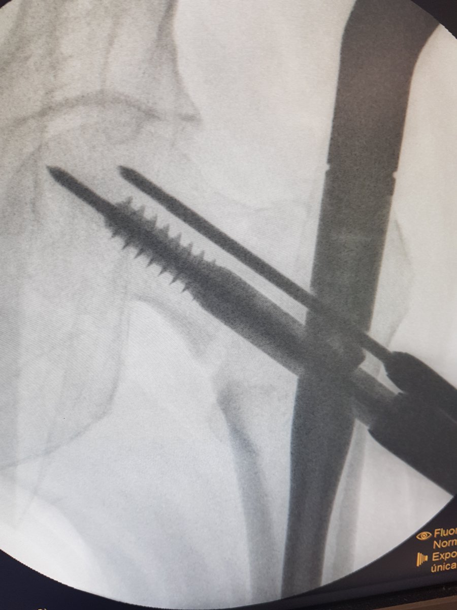 AlbertoLopezAr1's tweet photo. Fractura  basicervical: ROTACIÓN  de la cabeza femoral con la introducción del tornillo cefálico

foto 1 y 2: reducción durante la introducción del tornillo cefálico
foto 3y 4: se observa la perdida de reducción. Nótese el cambio de posición de la aguja antirrotatoria

hilo... https://t.co/XavE3V85mR