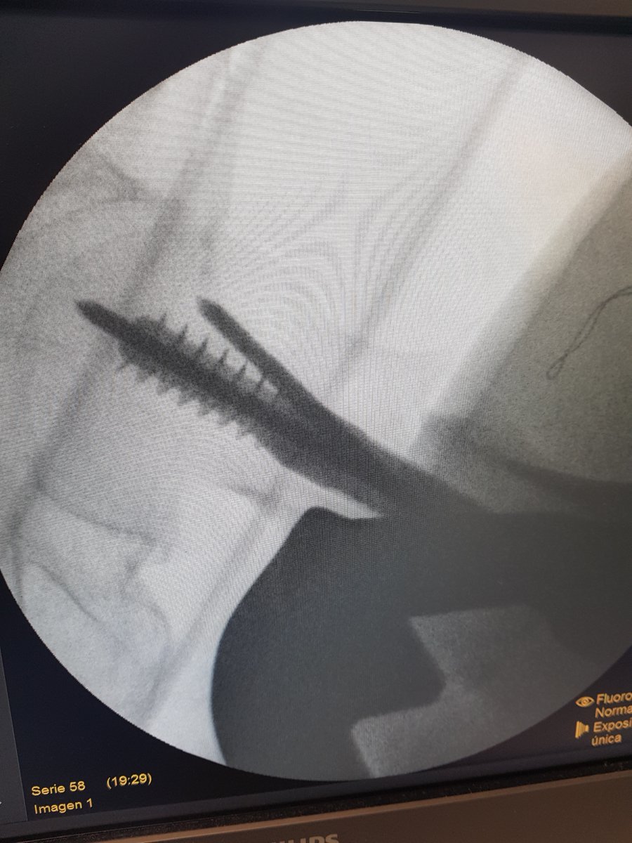 AlbertoLopezAr1's tweet photo. Fractura  basicervical: ROTACIÓN  de la cabeza femoral con la introducción del tornillo cefálico

foto 1 y 2: reducción durante la introducción del tornillo cefálico
foto 3y 4: se observa la perdida de reducción. Nótese el cambio de posición de la aguja antirrotatoria

hilo... https://t.co/XavE3V85mR