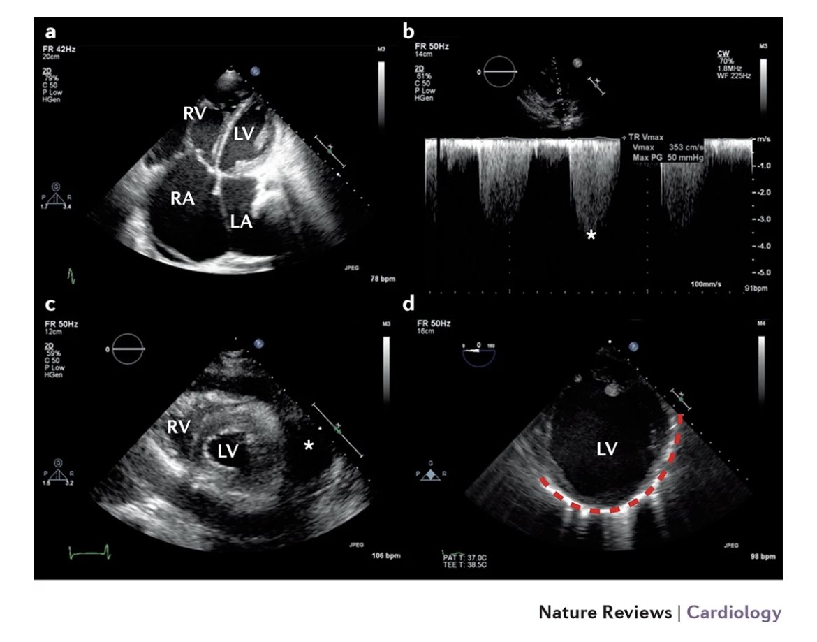 pocus_today's tweet photo. ✍️✍️Echocardiography &amp; Lung Ultrasound for the assessment and management of acute heart failure. Click Alt for image explanation. 

Nature Reviews 🔗🔗 https://t.co/b6lwiFBHtD #echofirst #FOAMed #FOAMcc https://t.co/HJoBeZBSC9
