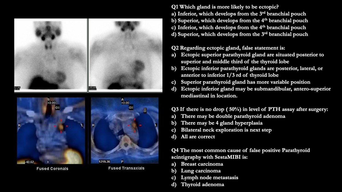 Case Challenge: # 87
Test your skills by providing answers in comments. 
Come back to check the answer key in 24 -48h.
#imaging #radiology #nuclear #petct #nucmed