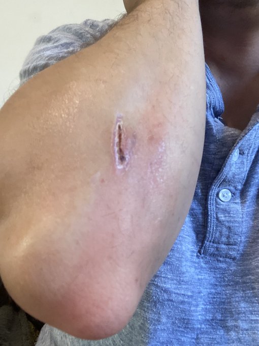 Wound update. The flap of skin there in between the dark perimeter lines is almost completely numb https://t<a href="/tag/thecrickets"class="tags"><span>#thecrickets</span></a>