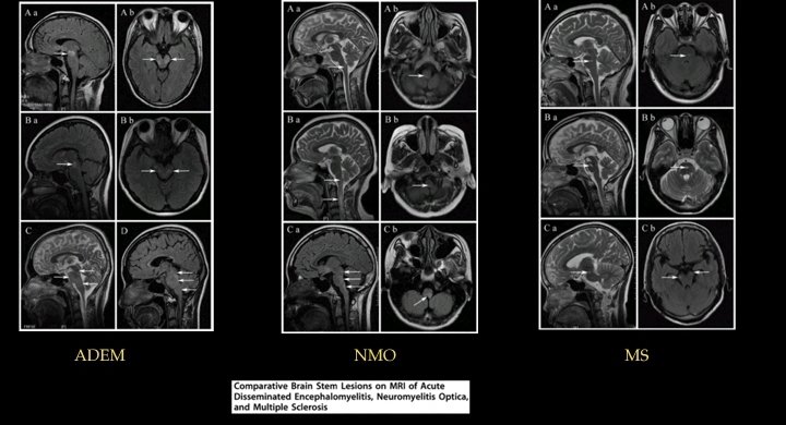 RCHPedneuro's tweet photo. Another great session..truly 🌏 participation at the 🇮🇳Peds Neuroscience session,thank expert panelists @drmankad @cesaralvesneuro Prof Shroff,Prof Boltshauser for their time and invaluable inputs.
Thank all case contributors,  fellows consultants, @nihaal08 for the moderation. https://t.co/ZbFTZR7hFy
