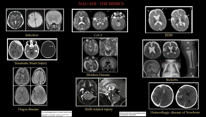 RCHPedneuro's tweet photo. Another great session..truly 🌏 participation at the 🇮🇳Peds Neuroscience session,thank expert panelists @drmankad @cesaralvesneuro Prof Shroff,Prof Boltshauser for their time and invaluable inputs.
Thank all case contributors,  fellows consultants, @nihaal08 for the moderation. https://t.co/ZbFTZR7hFy