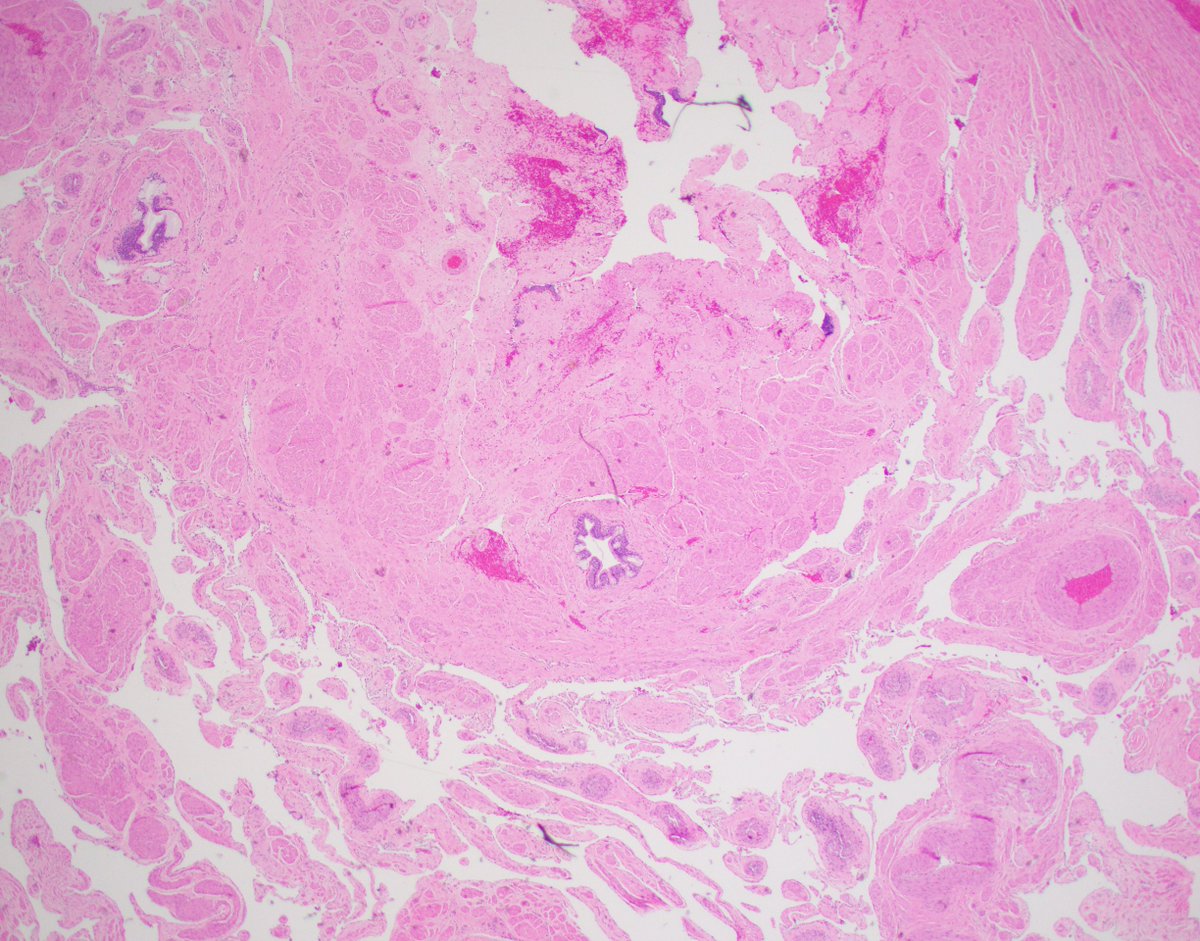 Urethral Strictures: a 🧵

32 year old with Hx of motor vehicle accident, pelvic bone fracture and urethral disruption. 

4 pieces received ranging up to 3.0 cm, a single section is submitted for histology. 

What would you do?

#GUPATH #pathology #pathres #urethra
