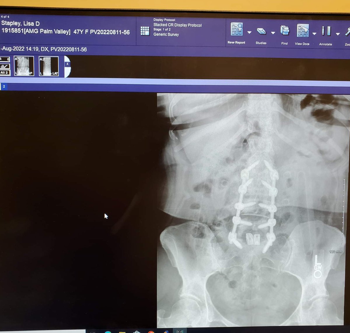 Cyberdyne has a new Cyborg...ME!

#scoliosis #BackPain