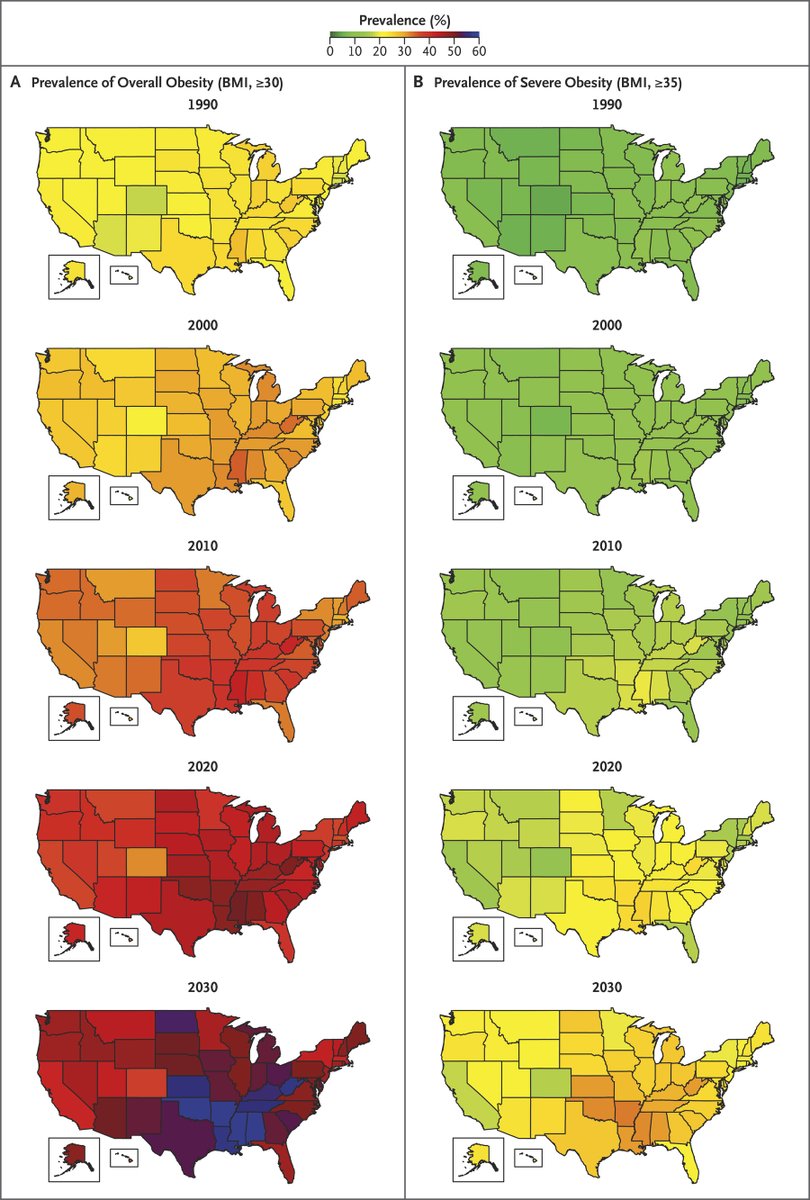 Peter_Nimitz's tweet photo. Severe obesity (BMI >35) will be more common in 2030 than overall obesity was in 1990. The healthiest state, Colorado, will almost as many (16.8%) severely obese people in 2030 as it had merely obese people in 1990 (17.9%). https://t.co/mYYSWOle0s https://t.co/FYfkUJymP7