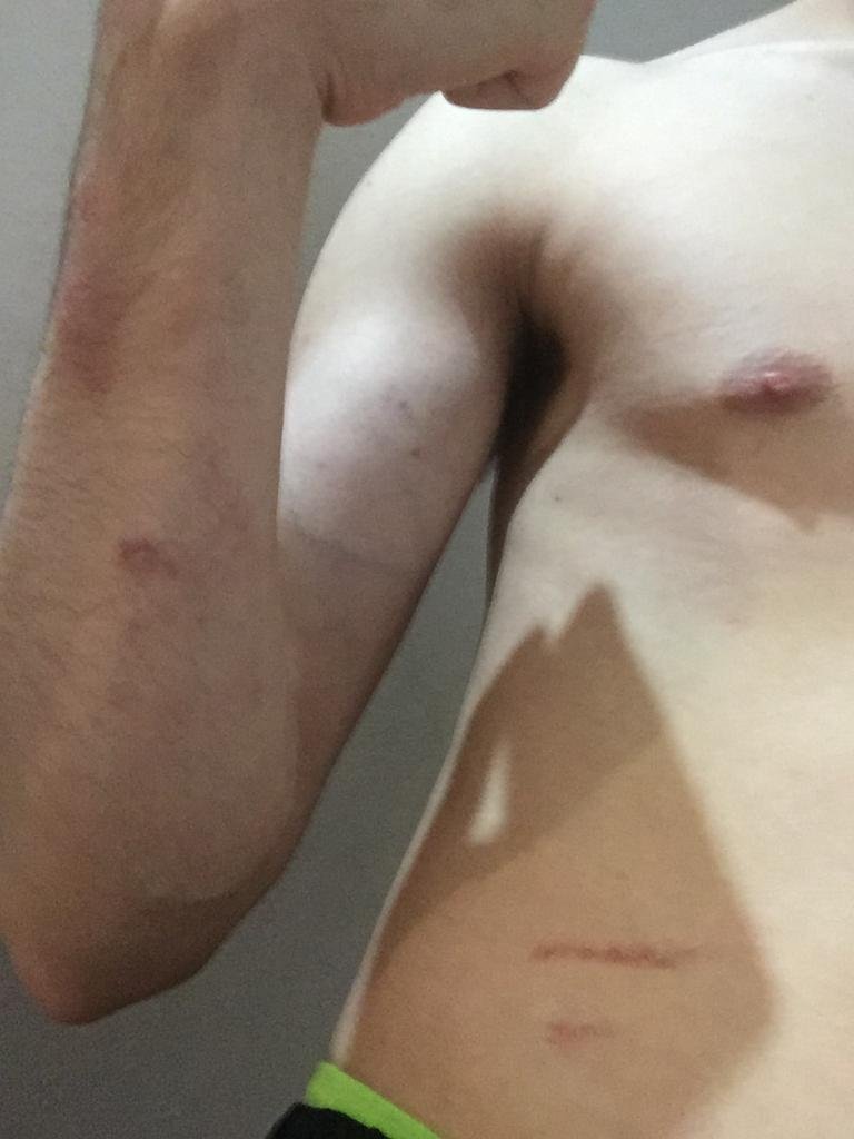 rubn_combatbuff's tweet photo. Little wounds from the fight, haha https://t.co/QkdYC2GJHe
