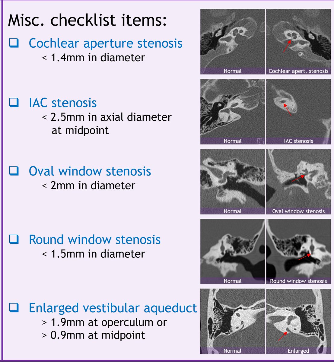 Cochlear abnormalities can be subtle and challenging. Here is an approach to help 👇 Our new congenital hearing loss course includes scrollable cases covering these diagnoses (and others) with discussions, annotated images and pearls: casestacks.com/neuro/fellowsh… #Radiology