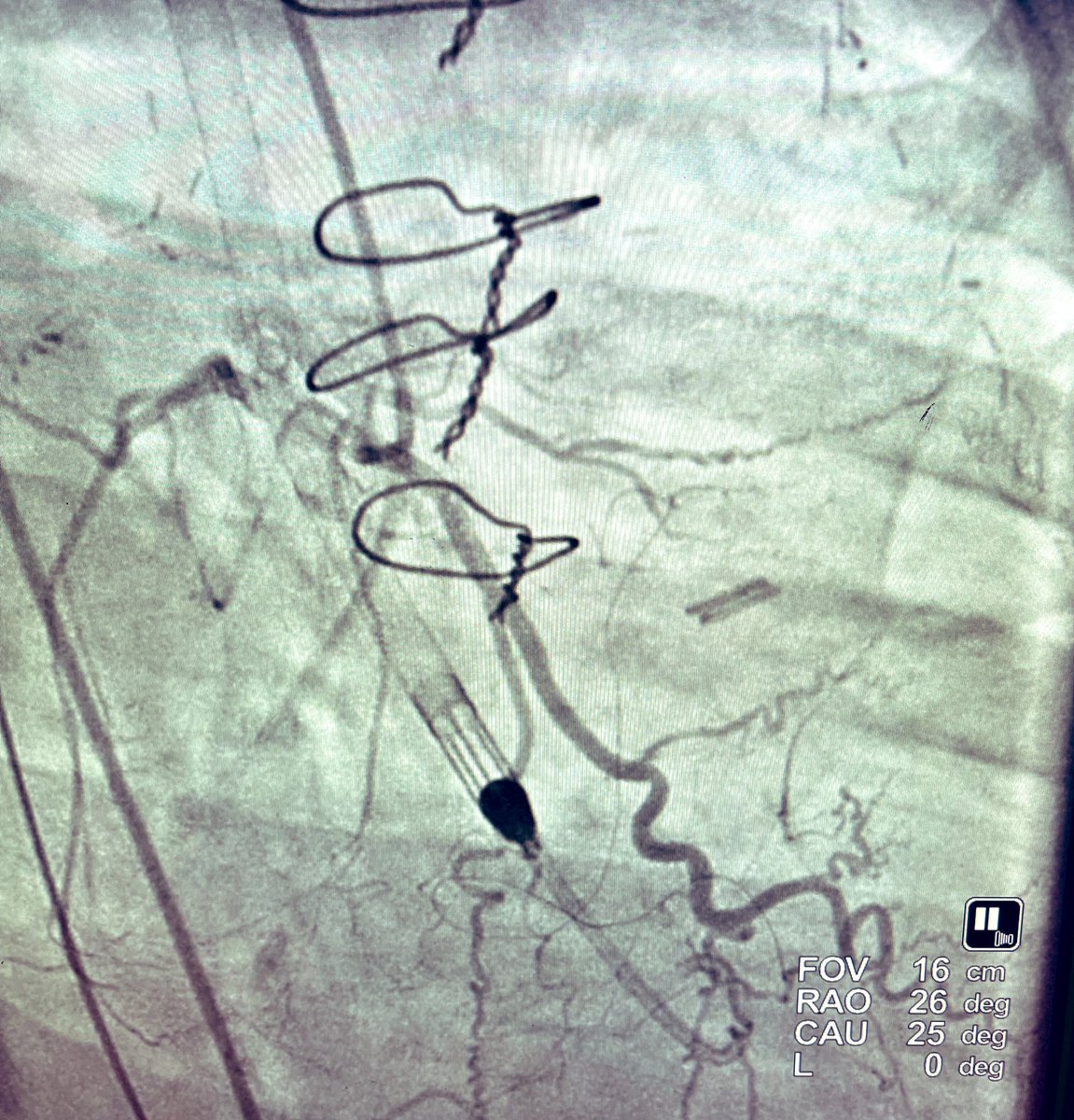 BaylorCardio's tweet photo. Final result after #Protected #PCI with #Impella @Abiomed and #plaque #modification with IVL @ShockwaveIVL #lithotripsy and @BSCCardiology #SYNERGY drug eluting stents #ACCFIT right to left collaterals not prominent post PCI. Impella weaned and access site closed with #proglide https://t.co/4h3r70jFpB