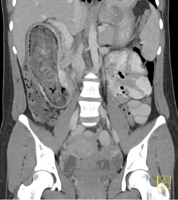 History: A 30-year-old female with a history of trichotillomania and trichophagia presented to the Emergency Department with abdominal pain, abdominal distention, and vomiting. Diagnosis? Source: UW #Radiology #meded #MedTwitter #radtwitter