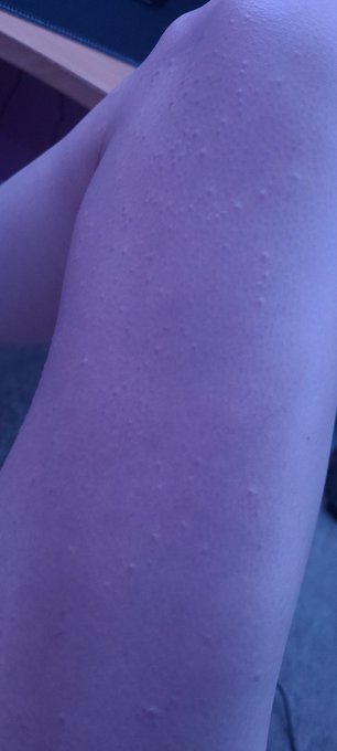 Had my 1st and last 5 guys burger today.  Fantastic burger,  but I am currently breaking out in hives