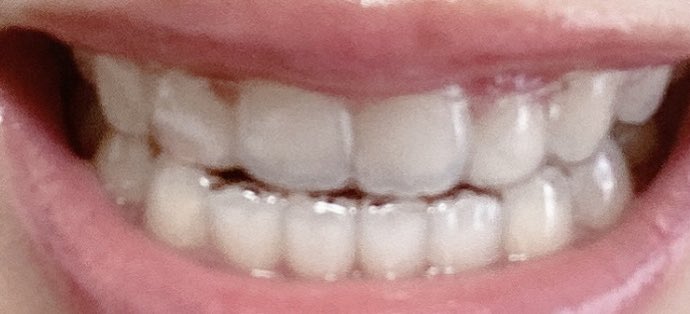 pcpph8888's tweet photo. リテーナーはアライナーに比べて薄いし、アタッチメントももうないから、パッと見ではつけてるのわからない！ https://t.co/3C0dKgV6DN