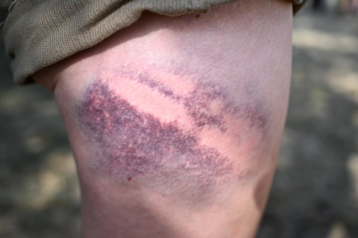 So sieht eine der Schlagstockverletzungen am Oberschenkel aus, die vielen Aktivist*innen gestern beim Polizeieinsatz gegen #endegelande zugefügt wurden. Diese entstand bei der Kattwykbrücke, wo der liliane Finger von der Polizei mit Pfefferspray &amp; Schlägen gestoppt wurde.