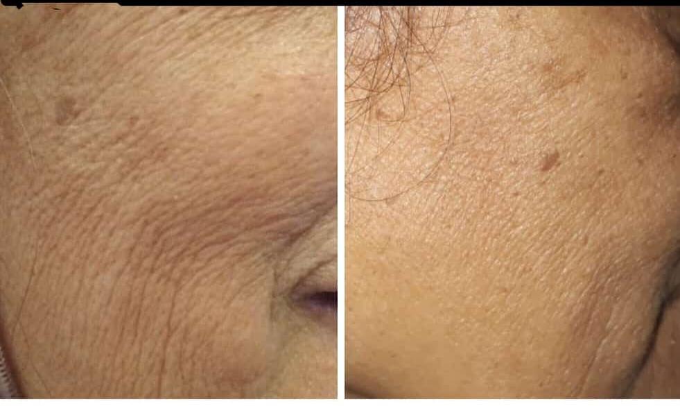DermoProf's tweet photo. This lady decided to test our products by only purchasing the Balancing Serum. She was shocked to see the difference in her skin texture, wrinkle appearance and tone in just two weeks! The proof is in the products developed by our pharmacist #antiaging #wrinkles #skincare https://t.co/V6h2dmTYnb