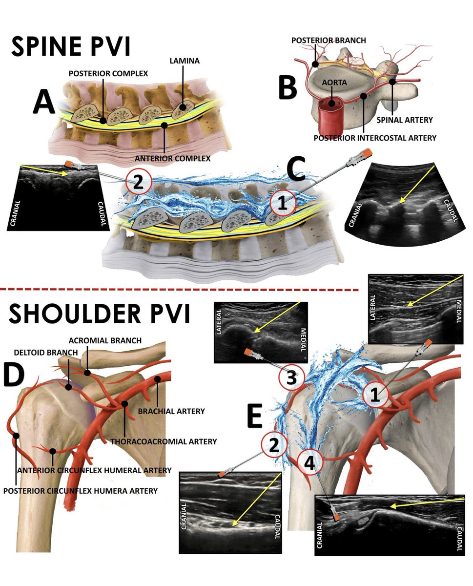 Roques_V's tweet photo. Finally we got it!!!! Alternatives for fast-track surgery in major joint surgery. WALANT?TRONCULANT?.......no....it's called PVI (Periarticular vasoconstrictor infiltration) thanks to @PabloOliverF @DrouotSport @sebebloc https://t.co/e8mUPJwJEM