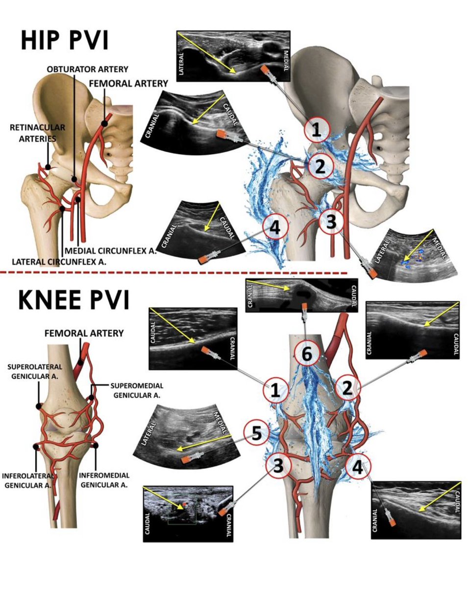 Roques_V's tweet photo. Finally we got it!!!! Alternatives for fast-track surgery in major joint surgery. WALANT?TRONCULANT?.......no....it's called PVI (Periarticular vasoconstrictor infiltration) thanks to @PabloOliverF @DrouotSport @sebebloc https://t.co/e8mUPJwJEM