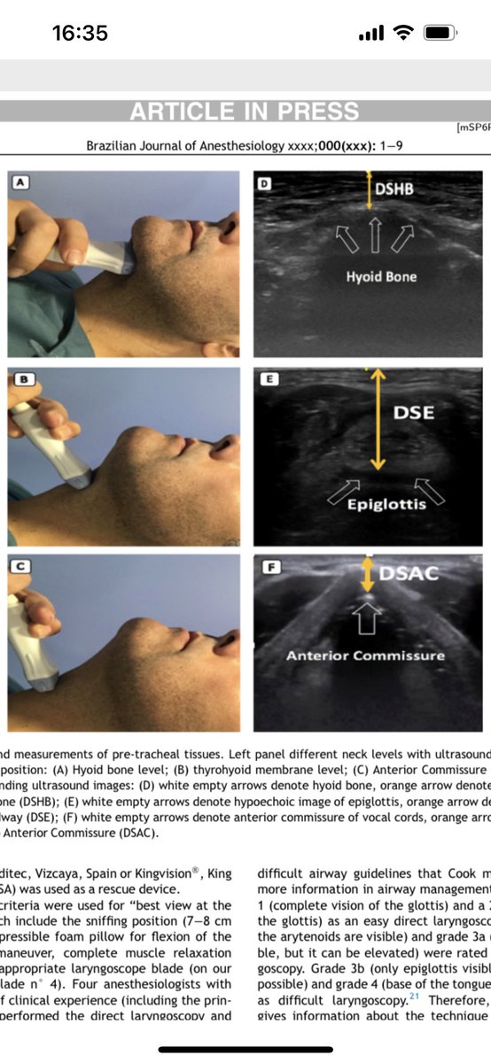 pocus_today's tweet photo. Preoperative airway ultrasound. Distance from skin to epiglottis (DSE) predicts difficult intubation. #POCUS #airway #anaesthesia 

✍️ by Fernandez-Vaquero et al. 

🔗 https://t.co/RwydWBnYUC https://t.co/0wQs04NhJX
