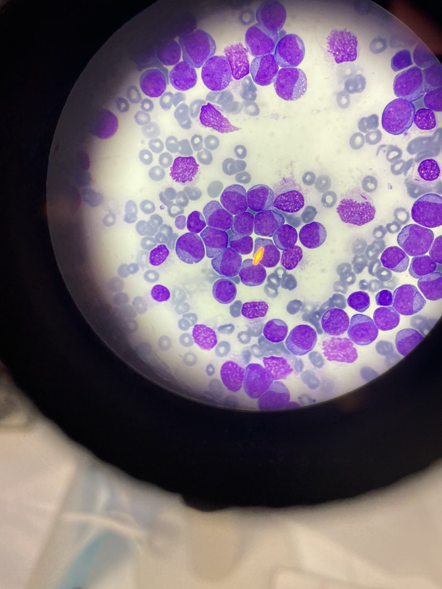50-yo female. Taken to the Emergency due to ten days history of fever and fatigue. WBC count: 350,000/μl. Blood smear compatible with acute myeloid leukemia. Diagnosis in just a drop of blood! 🩸🔬