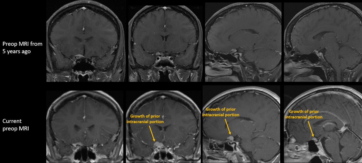 Jacques Morcos MD FRCS FAANS tweet media