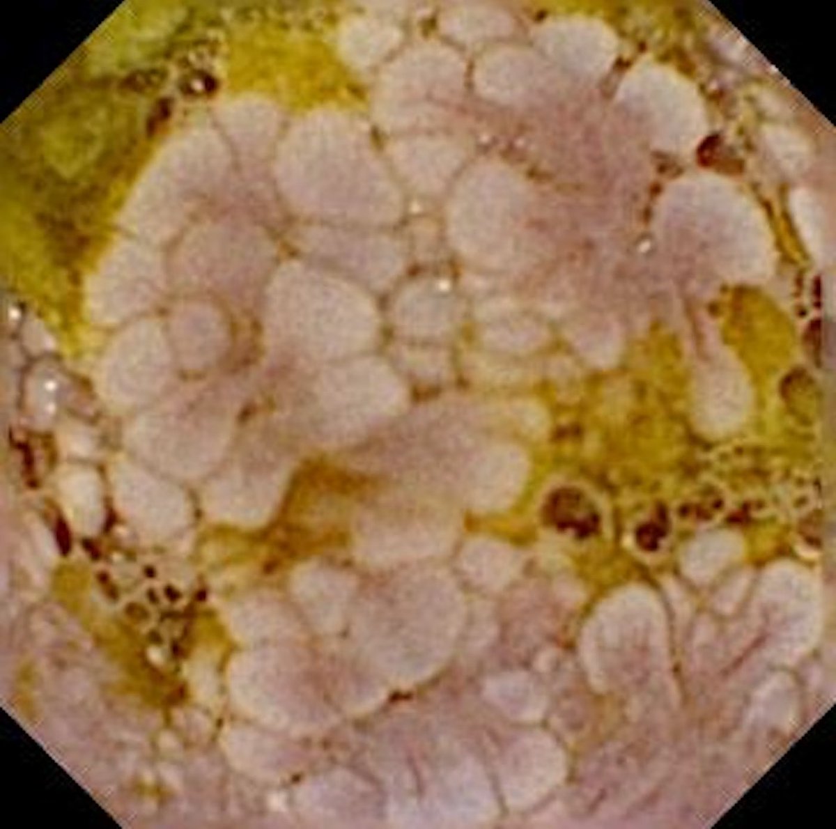 EndoCollab™ | GI Endoscopy Community tweet media