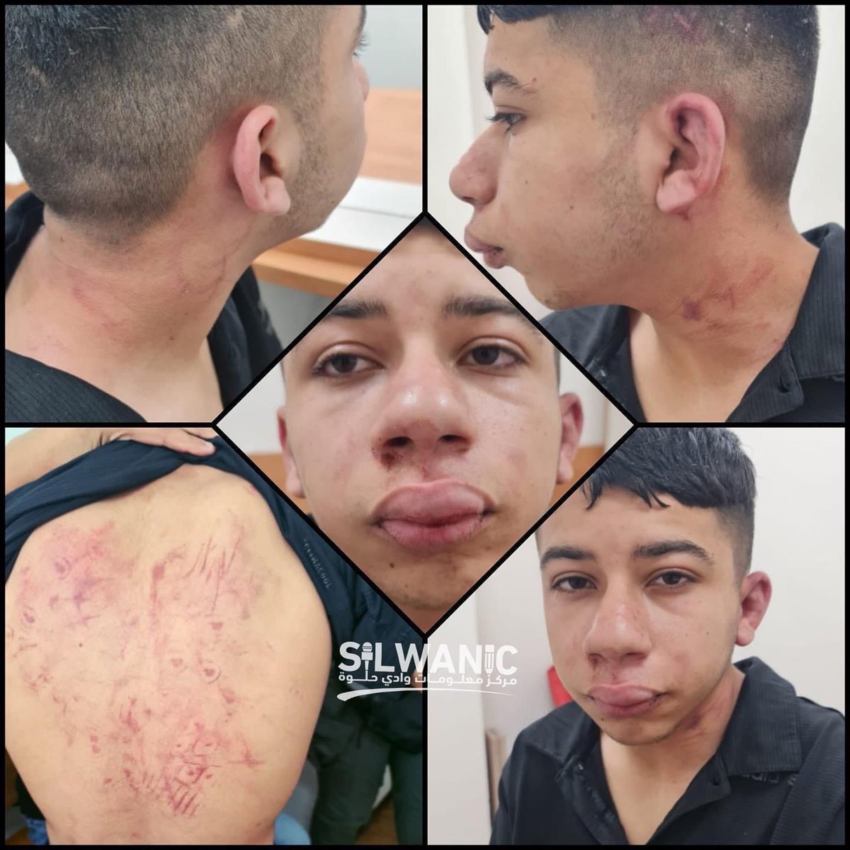 btselem's tweet photo. This is what the face of 15-year-old Majd Rweidi looked like after Israeli police officers and ISA agents violently dragged him out of bed and beat him. “I couldn’t believe it was my son. His facial features had completely changed,” his father later recounted. > https://t.co/XGrddTsm47