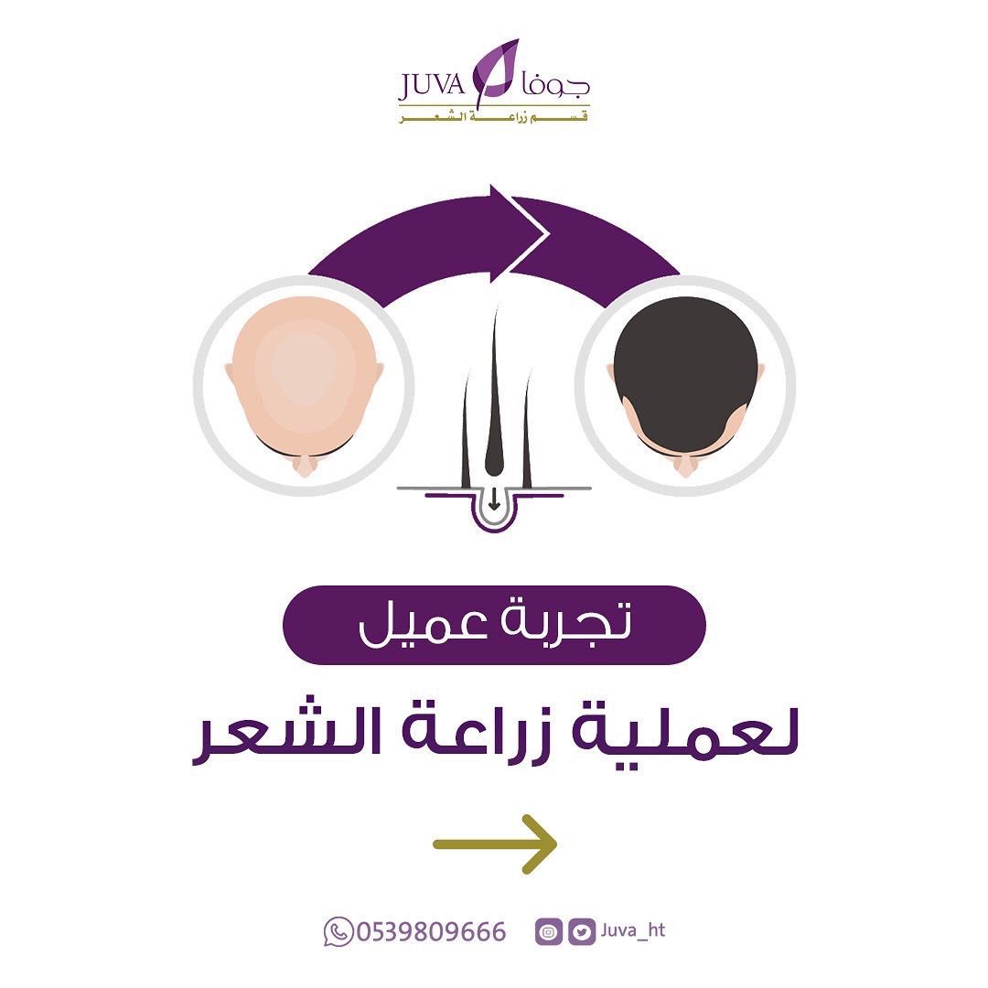 Juva_ht's tweet photo. تجربة عميل لعملية زراعة الشعر 🤩💜

للإستفسار يُرجى التواصل معنا عبر أرقام الإتصال أو عبر الواتس أب 🌺

📍الرياض ، شارع التخصصي
0114809666 أو 0539809666

#جوفا 
#جمال_يتجدد https://t.co/CuCOjY1lvX